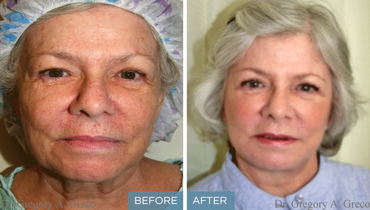 Facelift, Eyelift & Facial Fat Grafting (Female, 71)