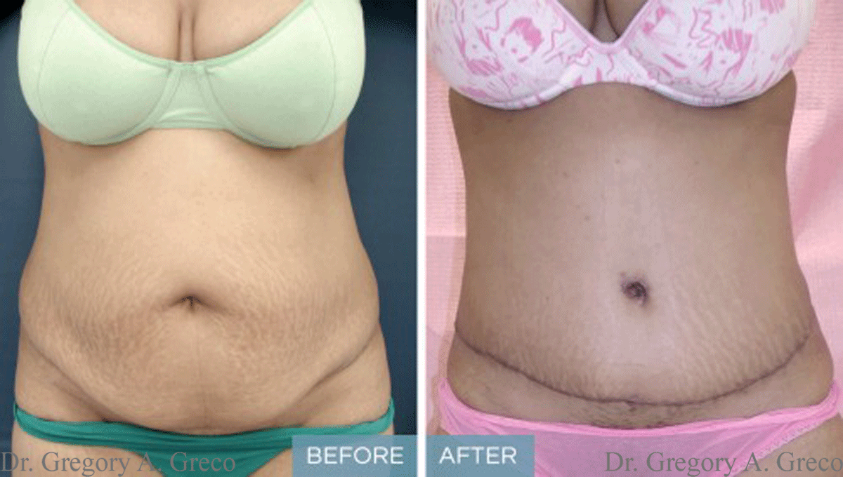 Abdominoplasty & Liposuction (Female, 33)