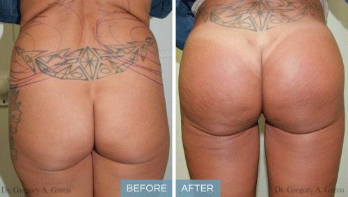 Buttock Augmentation (Female, 48)