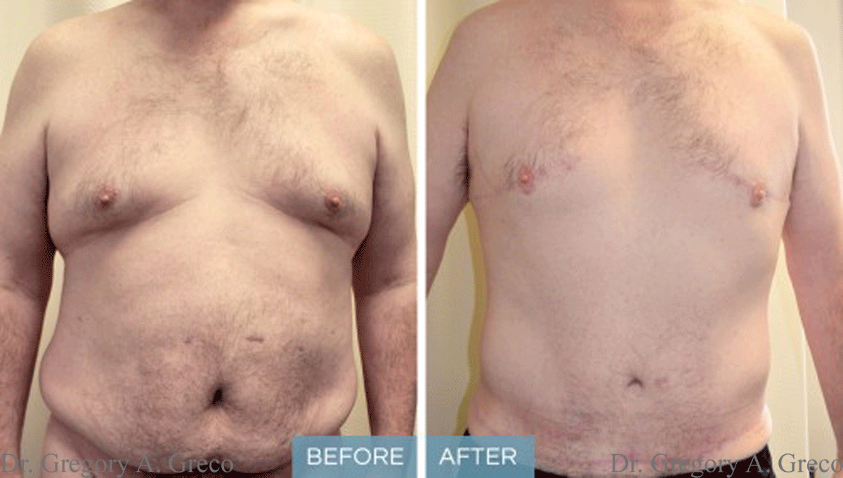 Abdominoplasty, Liposuction & Breast Reduction (Male, 47)