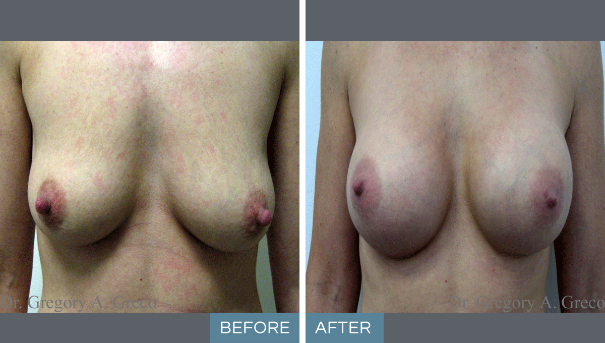 Breast Augmentation & Nipple Reduction (Female, 37)