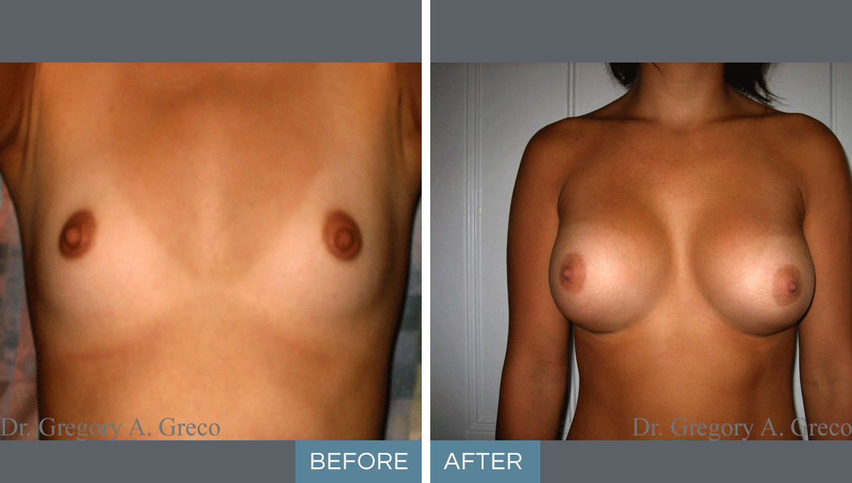 Silicone Breast Augmentation (Female, 23)