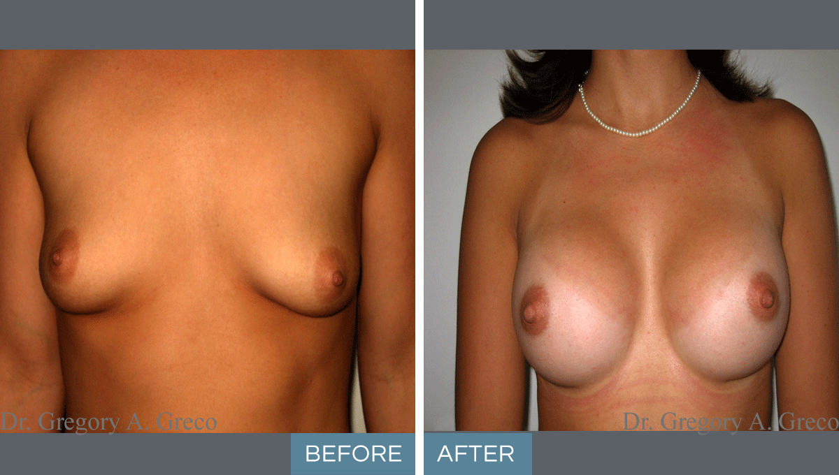Silicone Breast Augmentation (Female, Age Undisclosed)
