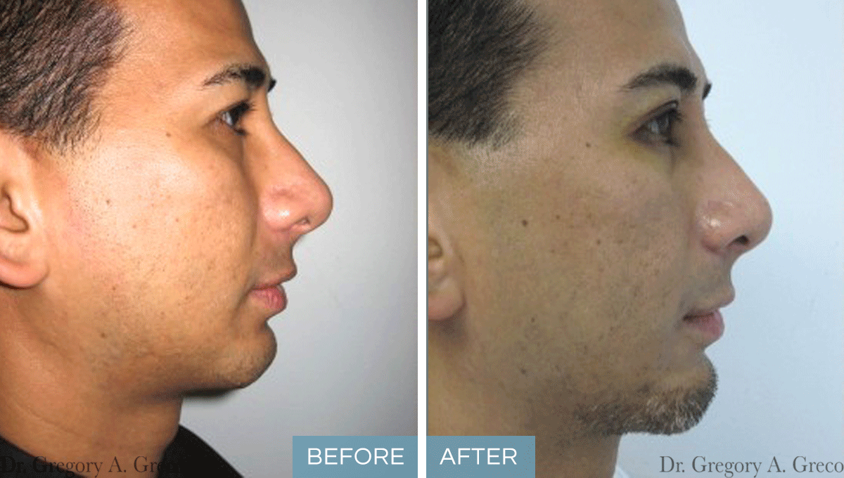 Chin Implant (Male, 35)