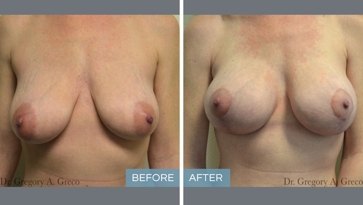 Breast Augmentation (Female, 36)