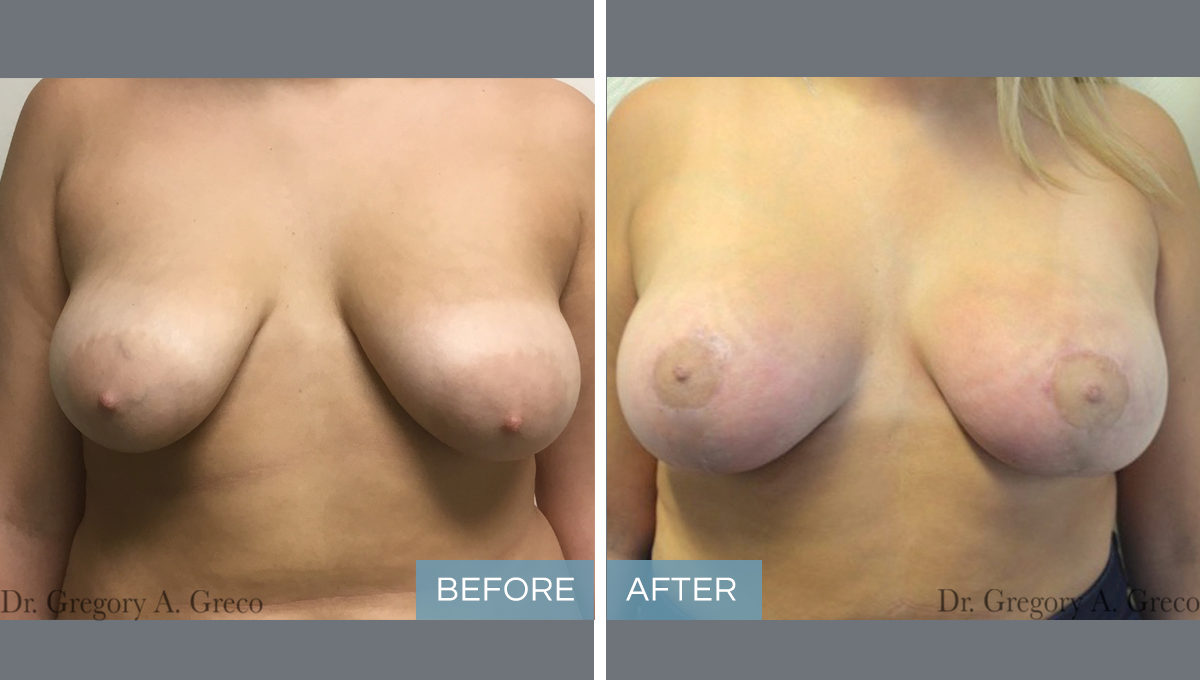 Breast Lift & Silicone Implant (Female, 21)
