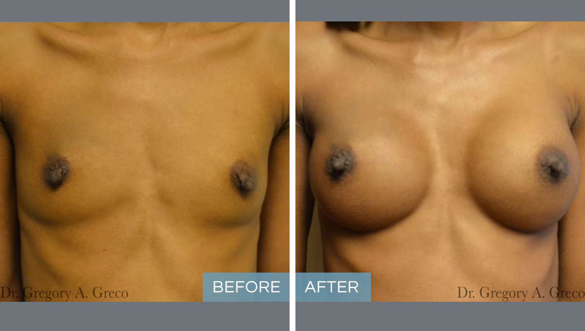 Silicone Breast Augmentation (Female, 24)